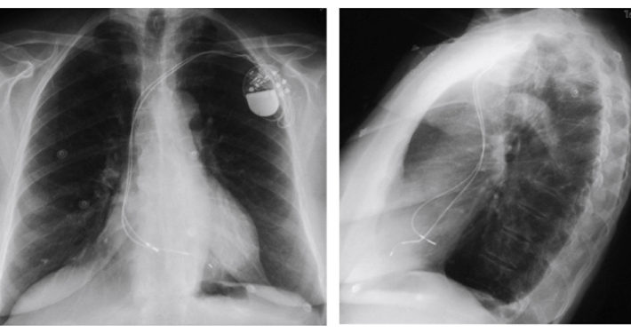 Radiografía pa y lateral de tórax que muestra generador doble cámara con el cable auricular situado en la región septal baja, próximo al ostium del seno coronario.