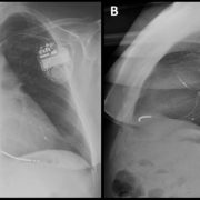 FIGURA 2: Radiografías de tórax post-implante. Proyecciones PA (izquierda) y lateral (derecha), mostrando la posición septoapical del electrodo de VD y lateral media del electrodo de VI.