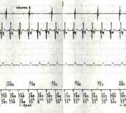 Figura 1. Electrogramas intracavitarios mostrando el inicio de uno de los episodios de taquicardia ventricular sostenida.